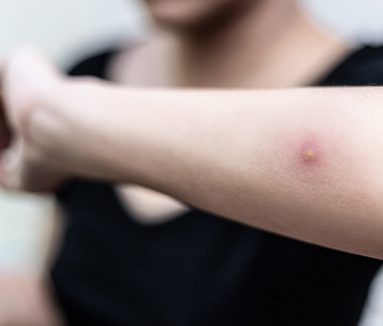 Incision & Drainage | Grace Dermatology & Aesthetics